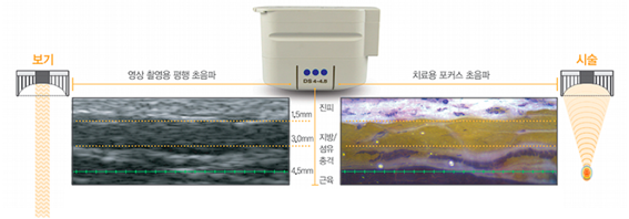 애슬리의원 탄력 리프팅 상세 안내 이미지