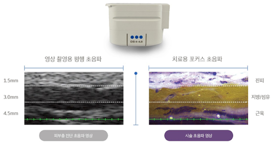 애슬리의원 탄력 리프팅 상세 안내 이미지